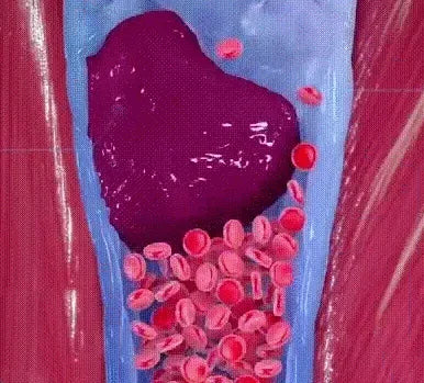 2 PCS Sumifun®Varicose Vein Cream✅ 7-Day Improvement Guarantee – Full Refund if No Results