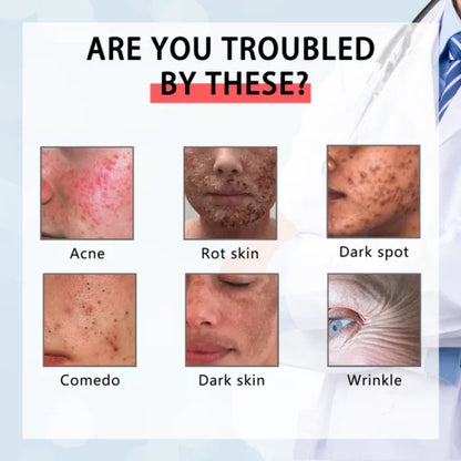 2025 NEW Warebrilla Acne Remover with Salicylic Acid