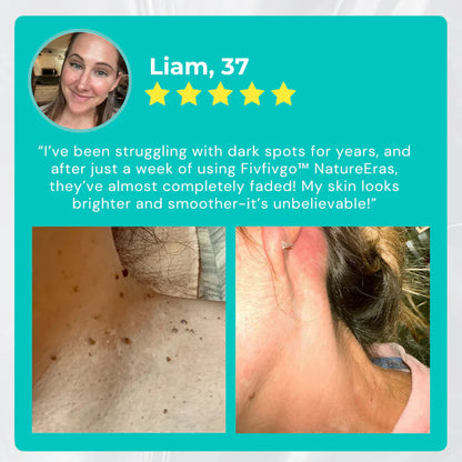 ✅ Official Store: Fivfivgo™ NatureErase Instant Mole & Spot Cream