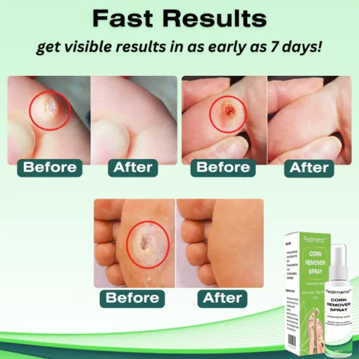 Pedimend™ corn removal spray