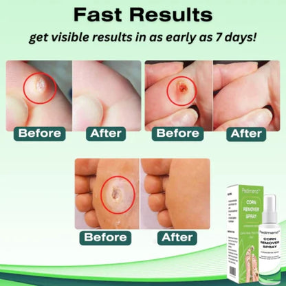 Pedimend™ corn removal spray